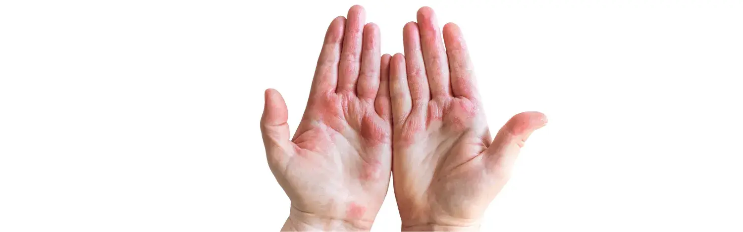 Hand Allergies from Disinfectants